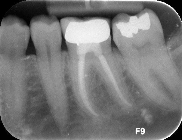 X-ray of damaged back tooth