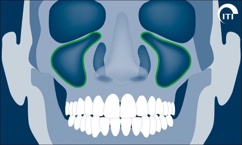 Animated rendering showing the right and left sinus