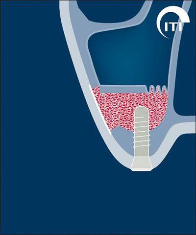 Animated rendering of dental implant post placed into grafted tissue