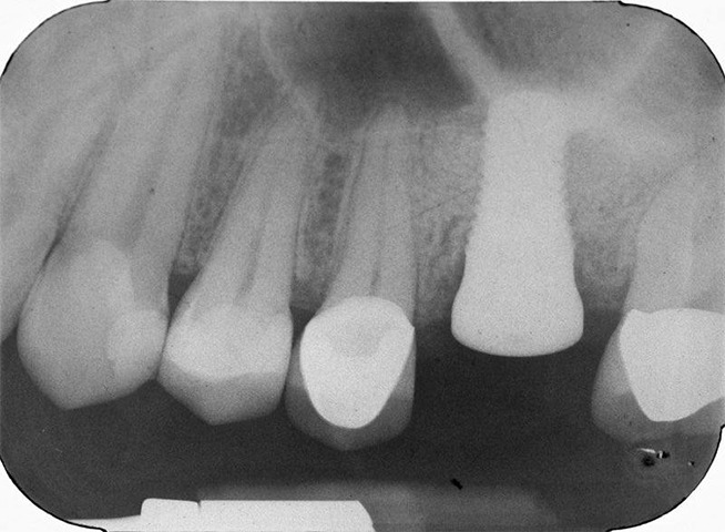 X-ray of dental implant in jawbone