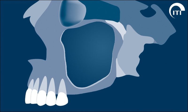 Animated rendering showing sinus expansion with missing molars