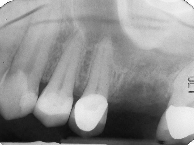 X-ray of smile with missing tooth and lack of supportive bone tissue