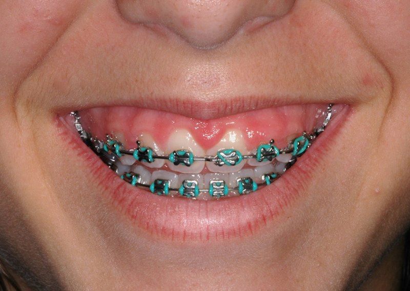 Stubby teeth with braces before aesthetic gum recontouring