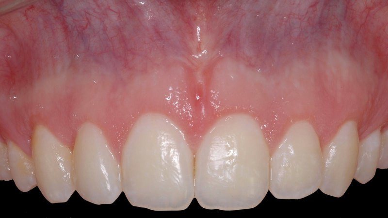 Smile after aesthetic gum recontouring