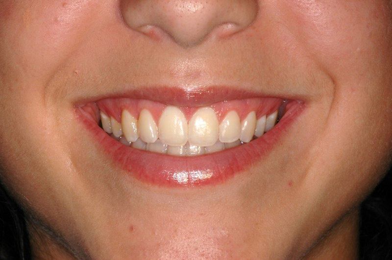 Full smile after aesthetic gum recontouring