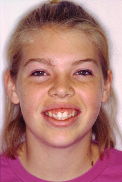 Young patient smiling before aesthetic gum recontouring