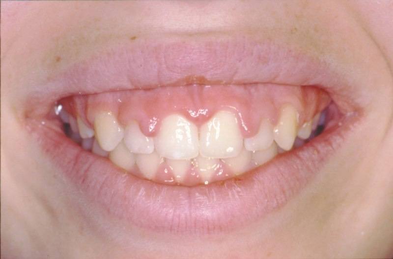 Uneven smile line before aesthetic gum recontouring