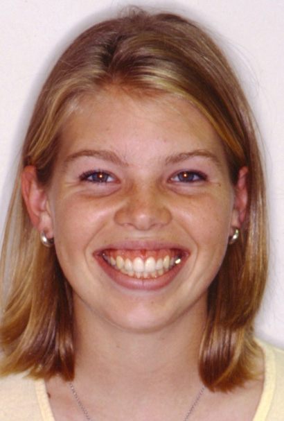 Patient smiling after Aesthetic gum recontouring