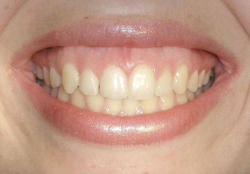 Beautiful smile five years after aesthetic gum recontouring