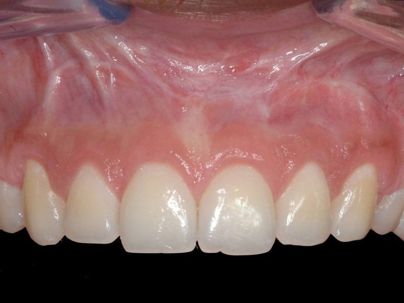 Beautiful smile after aesthetic gum recontouring