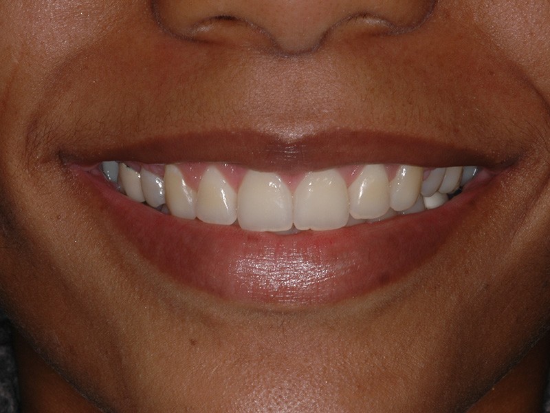 Closeup of patient's healthy smile after aesthetic gum recontouring