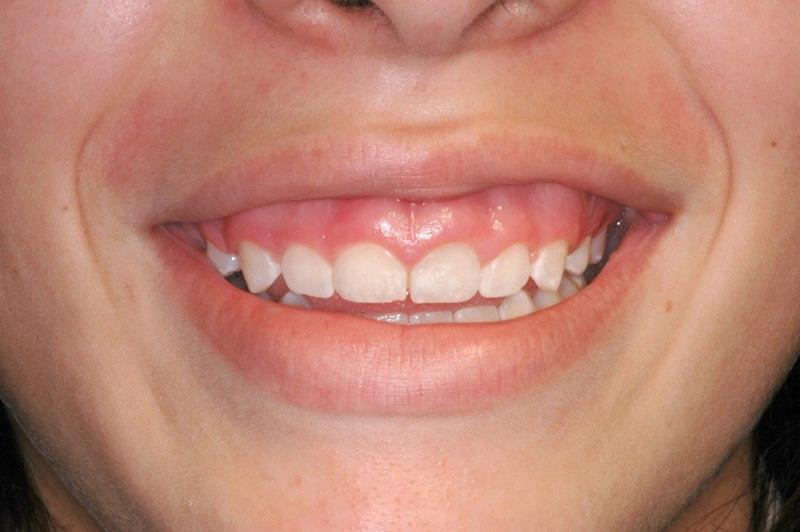 Closeup of smile stubby teeth and uneven gum line