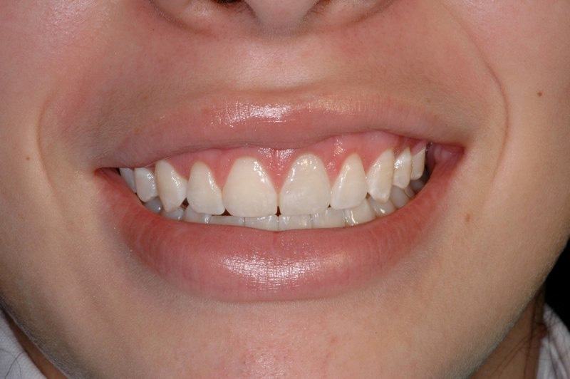 Patient's smile after aesthetic gum recontouring