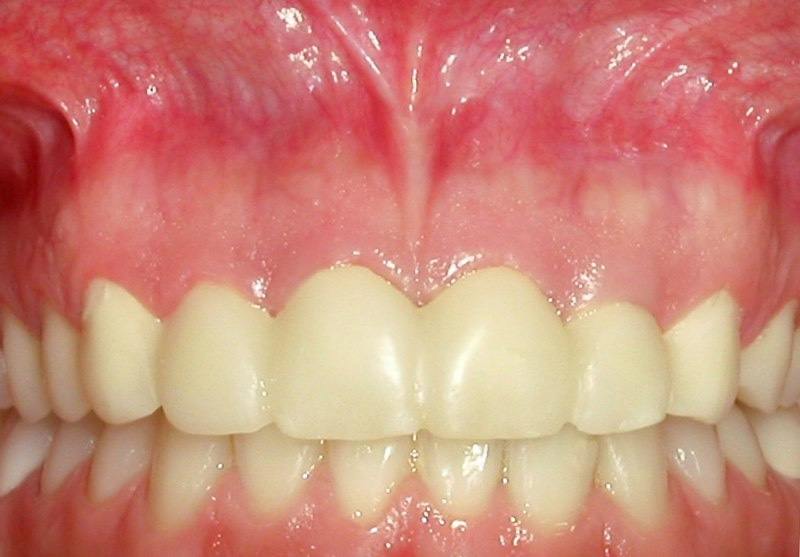 Closeup of smile in need of aesthetic gum recontouring