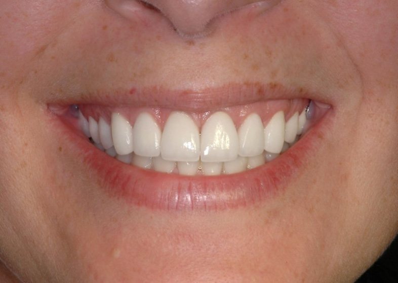 Gorgeous smile after aesthetic gum recontouring