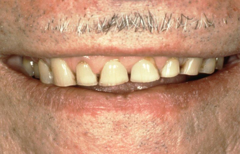 Stubby damaged teeth before aesthetic gum recontouring