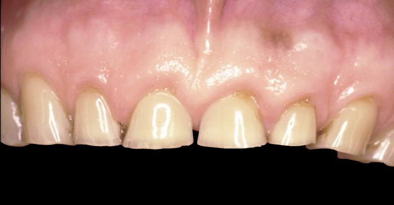 Top row of teeth after severe wear