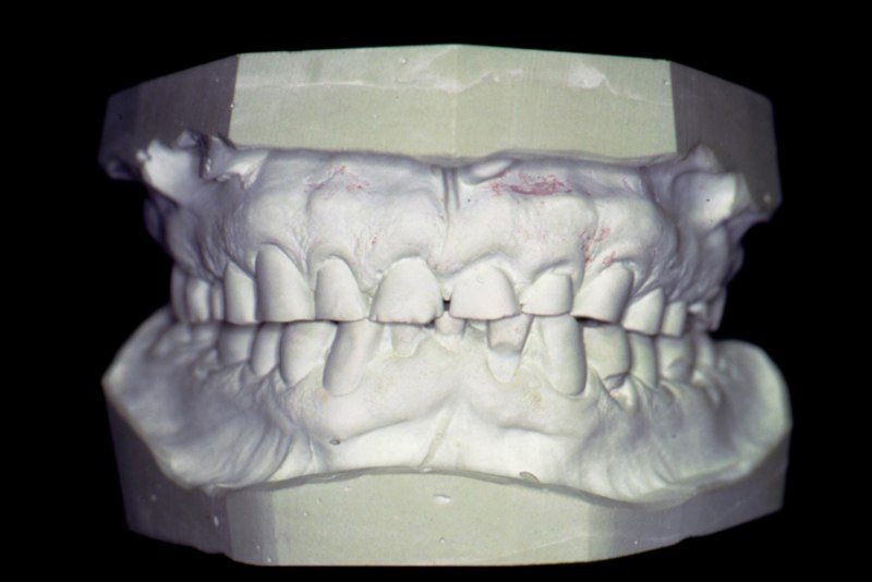 Model of smile before treatment
