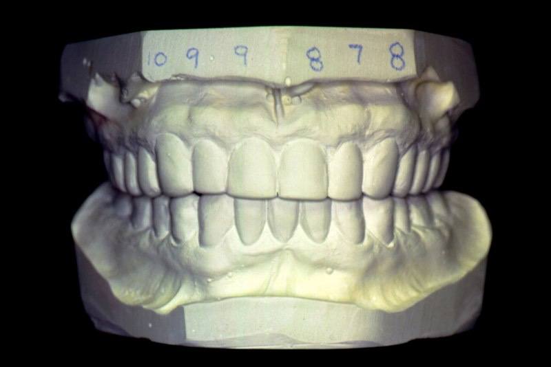 Model of smile after treatment