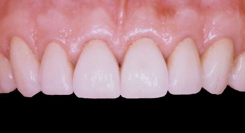Closeup of smile after aesthetic gum recontouring and dental crown restoratoin