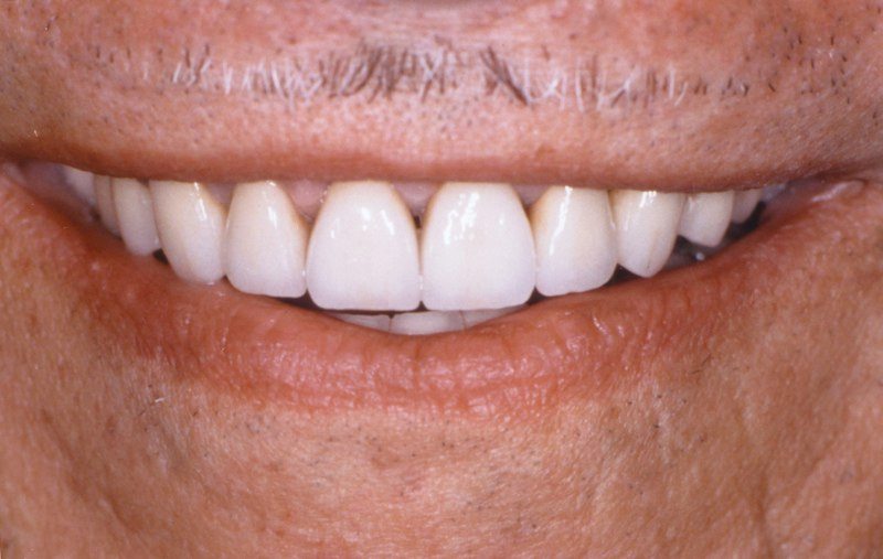 Closeup of smile after aesthetic gum recontouring and dental crown resotration