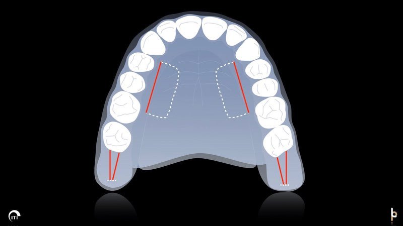 Animated rendering of sites on the roof of the mouth used for tissue donation