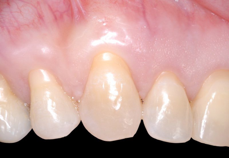 Smile with gum tissue recession in need of gum grafting