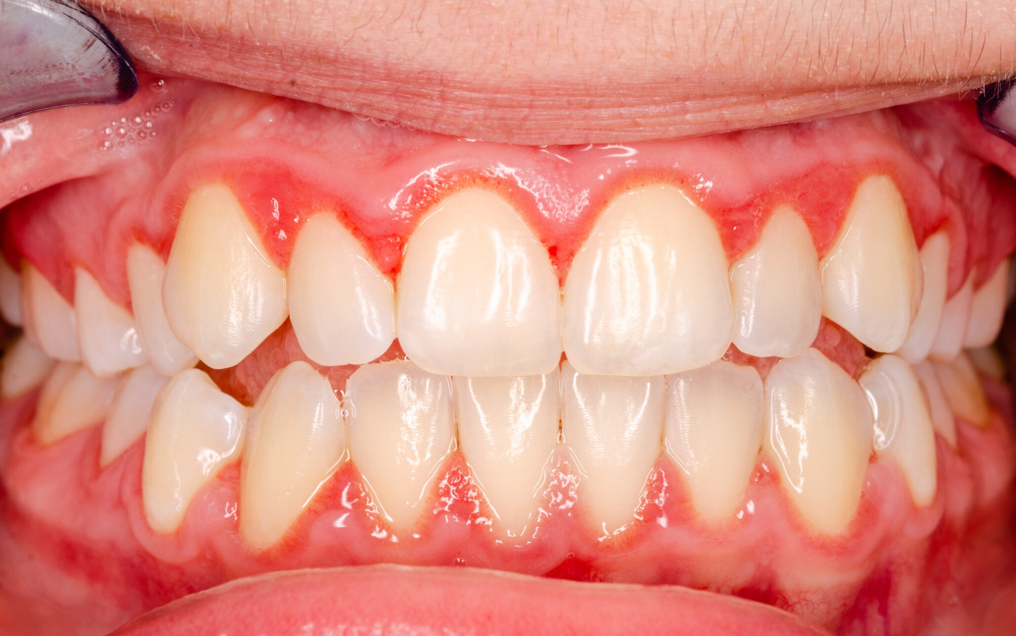 how-to-treat-gummy-smiles-using-non-surgical-methods-dentistry