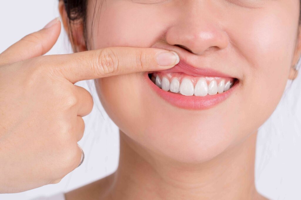 Woman pointing to her gums